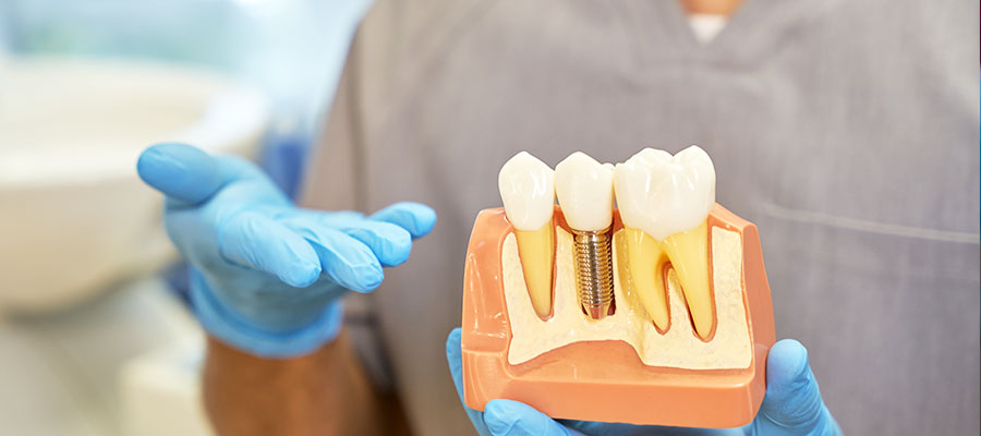 Dental Implants